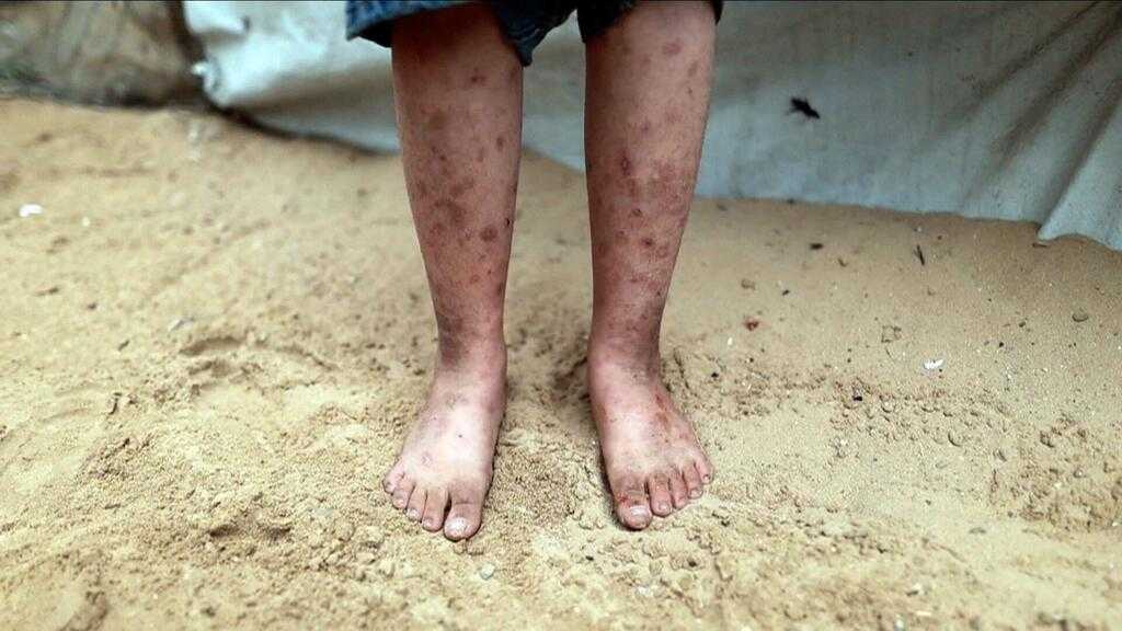 Gaza: Flambée d’infections cutanées chez des milliers de patients, alerte l’UNRWA